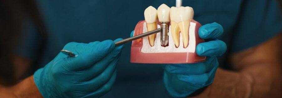 etapy-leczenia-implantologicznego-w-klinice-denticanova-od-konsultacji-po-osadzenie-korony