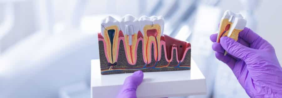 opracowanie-kanalu-korzeniowego-krok-po-kroku-przez-leczenie-endodontyczne