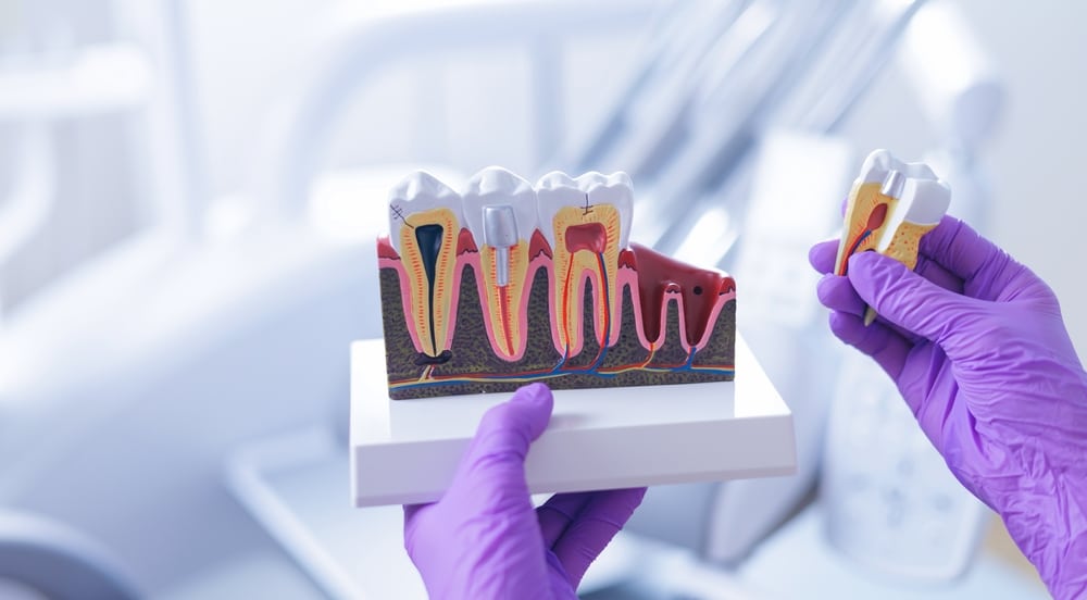 opracowanie-kanalu-korzeniowego-krok-po-kroku-przez-leczenie-endodontyczne